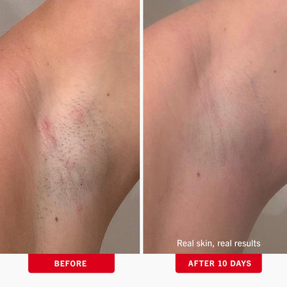 First Aid Beauty - Ingrown Hair Pads with BHA + AHA - Aftershave Treatment Pads to Help Prevent Razor Bumps for Men & Women - Exfoliate Underarms & Bikini Area - Compostable for Daily Use - 28 Pads